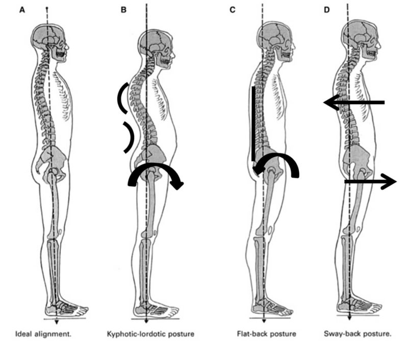 Posture Correction: Types of Bad Posture & How to Fix Them