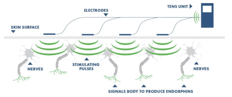 Tens Electrode Placement Chart Pdf